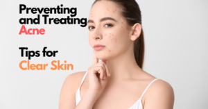 Preventing and Treating Acne – Tips for Clear Skin